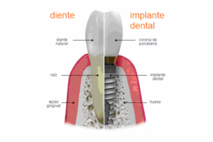 mplante2