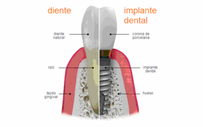 Un implante dental es una muy buena opción para restaurar tu sonrisa. Ven a vernos y te aconsejaremos…
