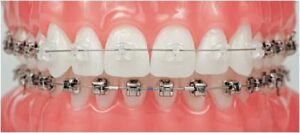 brackets