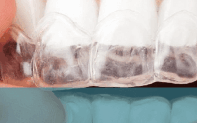 ¿Tú también rechinas o aprietas los dientes? ¡Tenemos la solución!