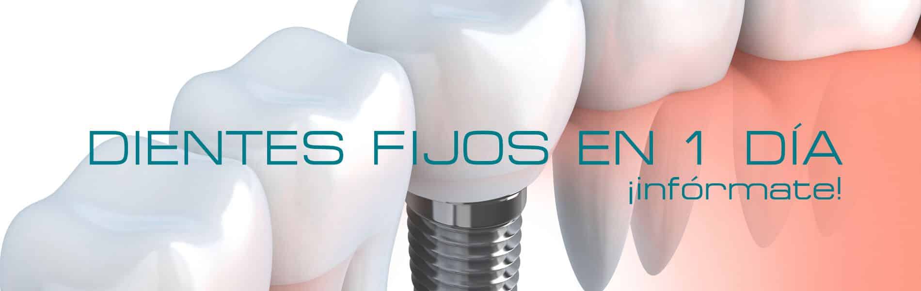 Dientes fijos en 1 día en Córdoba Dientes fijos en 1 día en Córdoba
