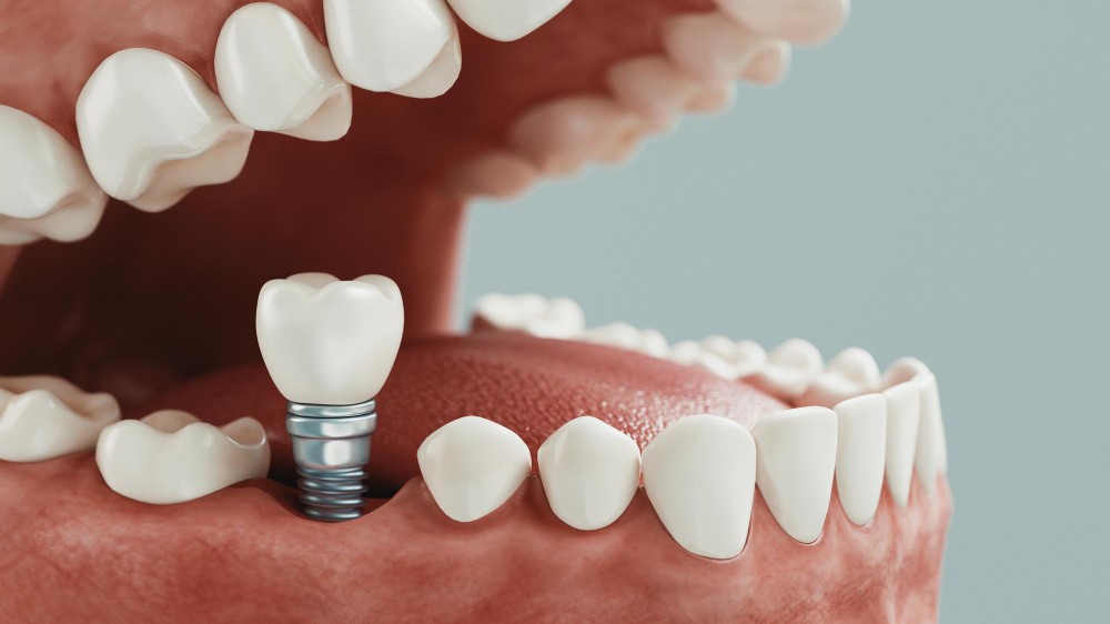 Precio de los implantes dentales en Córdoba Precio de los implantes dentales en Córdoba